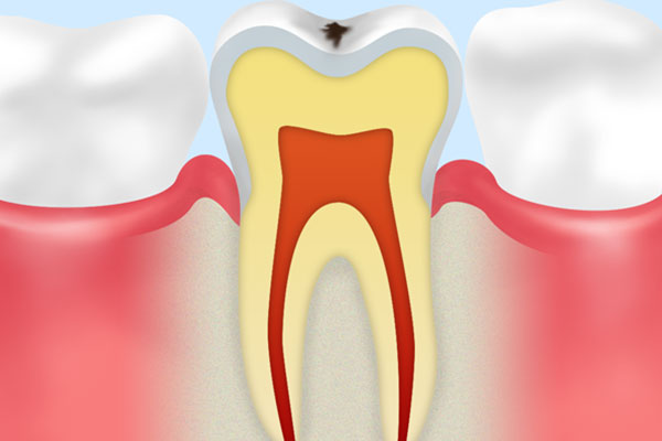C0　初期虫歯