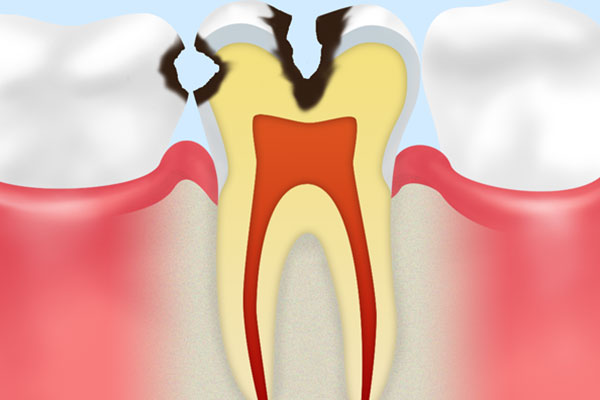 C2　象牙質の虫歯