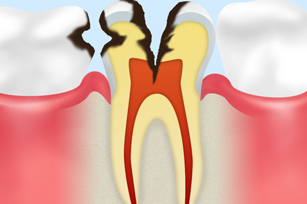 C3　神経の虫歯